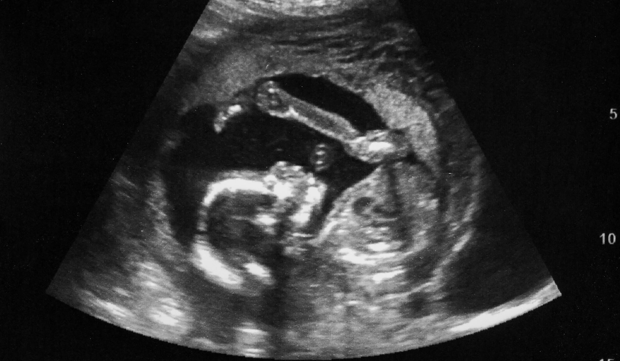 abortion-supreme-court-dobbs-brief-uses-fetal-ultrasound-images